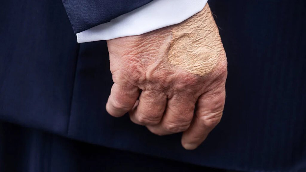 What is chronic venous insufficiency, Trump’s diagnosis?