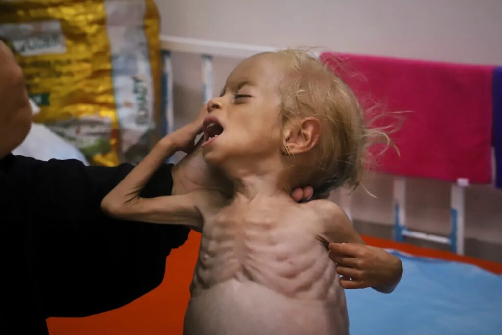 Malnourished kids arrive daily at a Gaza hospital as Netanyahu denies hunger