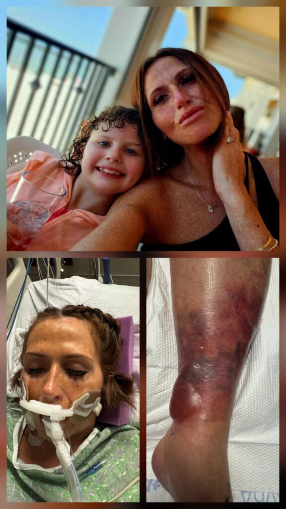 Flesh-eating bacteria tried to kill her. Here’s what it took to survive.