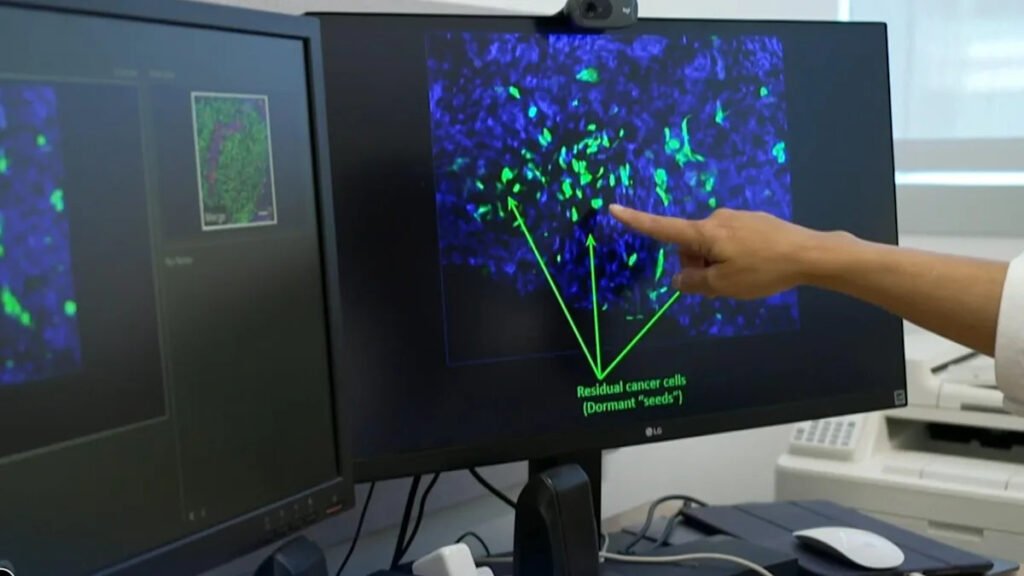 Researchers seek to halt breast cancer recurrence by targeting “sleeper cells”