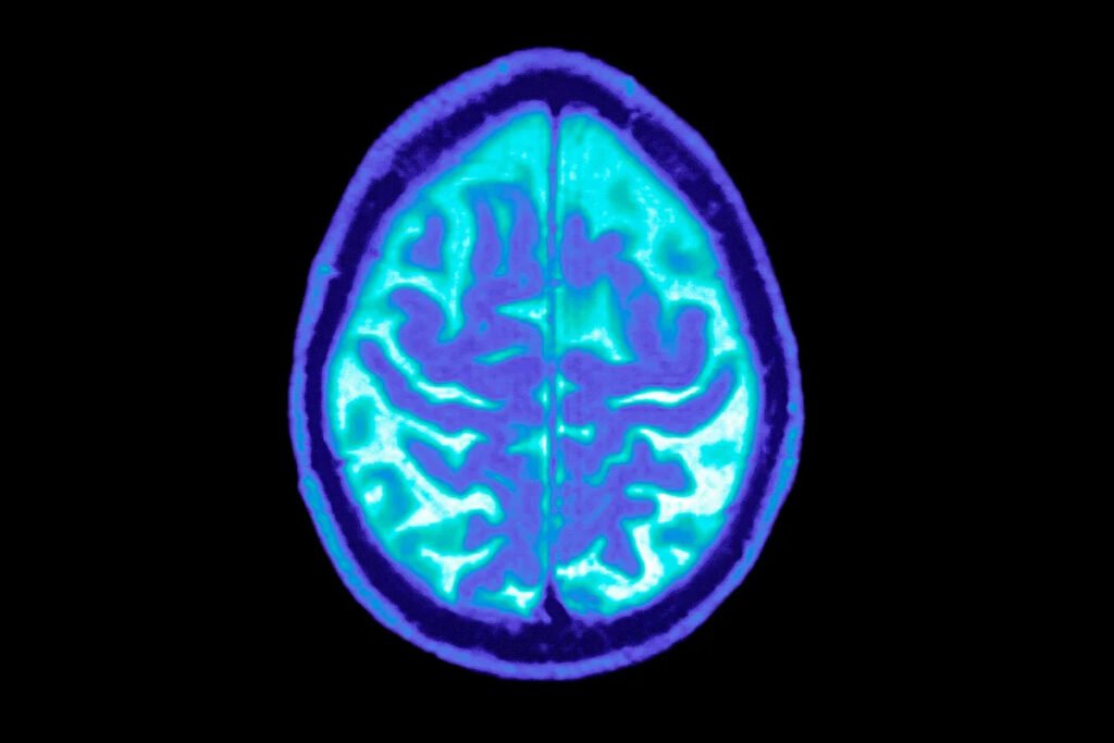 Novo Nordisk still sees potential for GLP-1 drugs for Alzheimer’s, despite trial setback